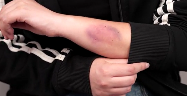 How to Make a Simple Fake Bruise (A Total of 3 Ways)