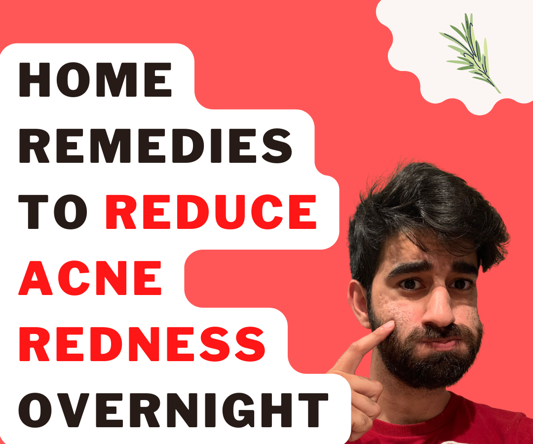 Home Remedies to Reduce Acne Redness Overnight