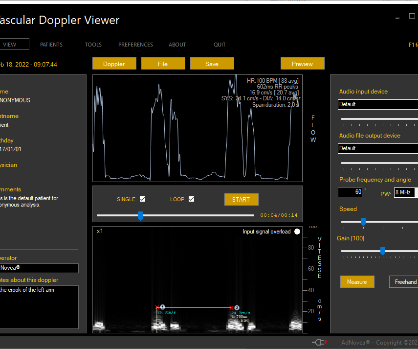Vascular Doppler Viewer - Low Cost Blood Flow Speed Measure